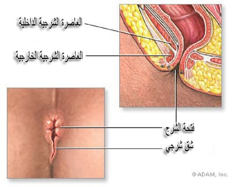 الشق الشرخي Anal Fissure