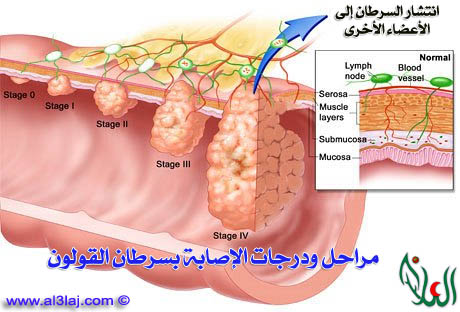 تحديد مراحل الإصابة بسرطان القولون مهم عند البدأ في العلاج