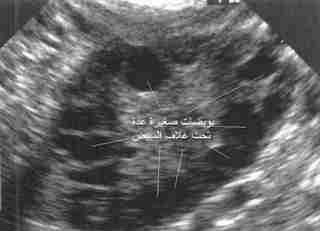بويضات صغيرة تحت غلاف المبيضين