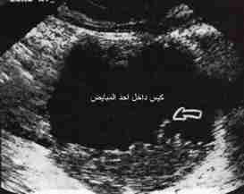 كيس داخل أحد المبايض