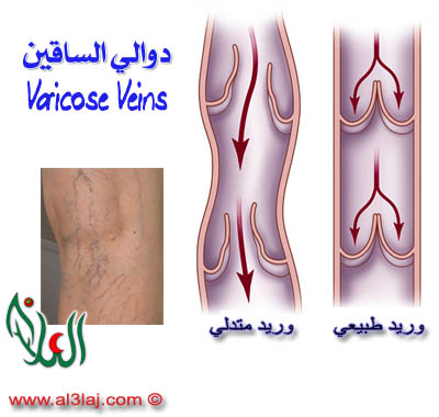 علاج دوالي الساقين