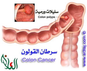 Colon Cancer 1