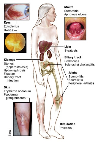 Crohns Disease complications