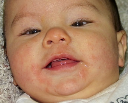 Dermatitis Eczema baby