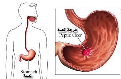 Gastric Ulcer cure 1
