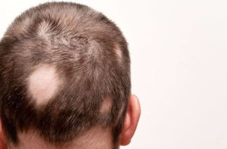 داء الثعلبة Alopecia Areata