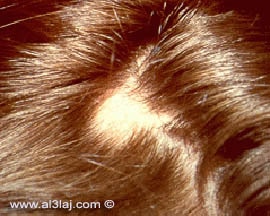 alopecia cure 1
