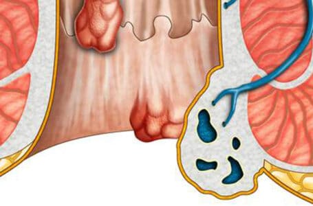 البواسير Hemorrhoids