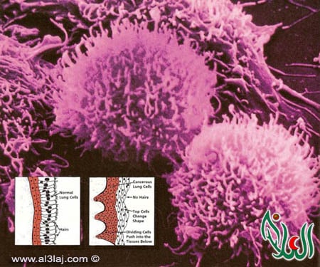 cancer cells 1