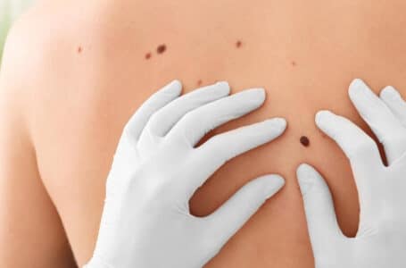 علاج سرطان الجلد
