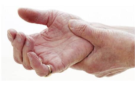 تفاصيل أهم مكونات العلاج الطبيعي الروماتويد ( Rheumatoid arthritis )