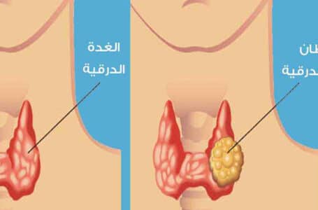 سرطان الغدة الدرقية ( Thyroid Cancer )تفاصيل مكونات العلاج الطبيعي