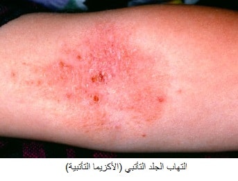 eczema atopic