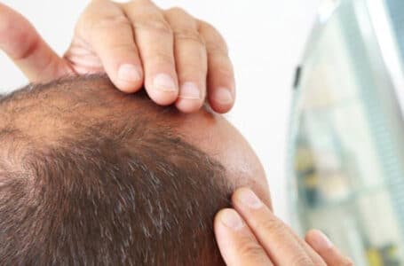 داء الثعلبة ( Alopecia areata )ملاحظات مهمة على استخدام العلاج الطبيعي