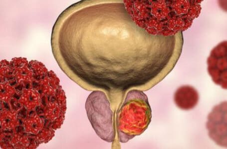 سرطان البروستاتا ( Prostate Cancer )ملاحظات مهمة على استخدام العلاج