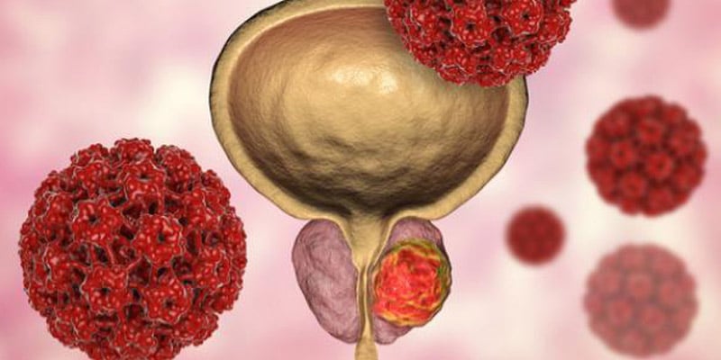 ملاحظات علاج سرطان البروستاتا