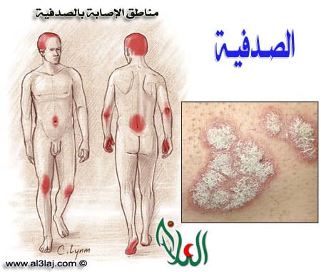 locations of psoriasis