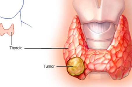 سرطان الغدة الدرقية ( Thyroid Cancer )ملاحظات مهمة على استخدام العلاج