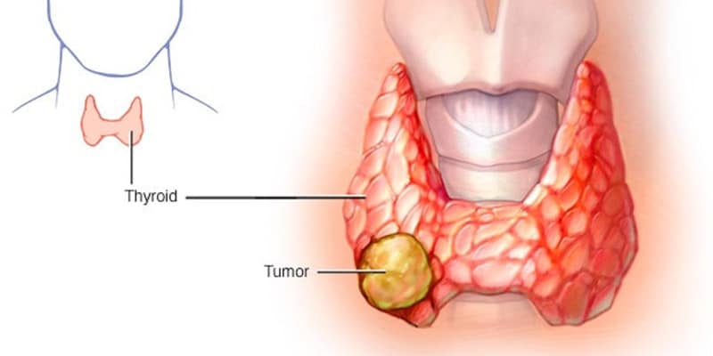 ملاحظات علاج سرطان الغدة الدرقية