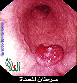 picture stomach cancer
