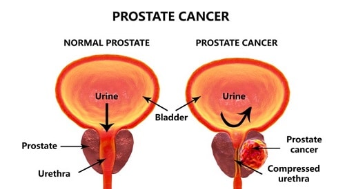 prostate cancer 1