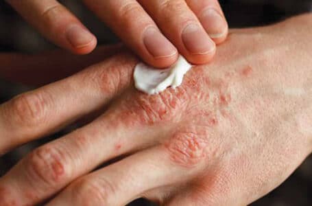 التهاب الجلد والأكزيما ( Eczema )ملاحظات مهمة على استخدام العلاج الطبيعي