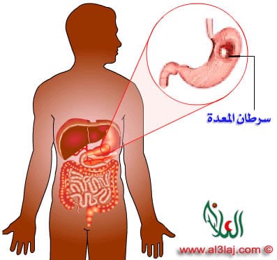 stomach cancer 1