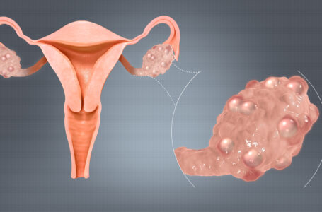 تكيس المبايض Polycystic ovary syndrome – جميع المعلومات عن هذا المرض