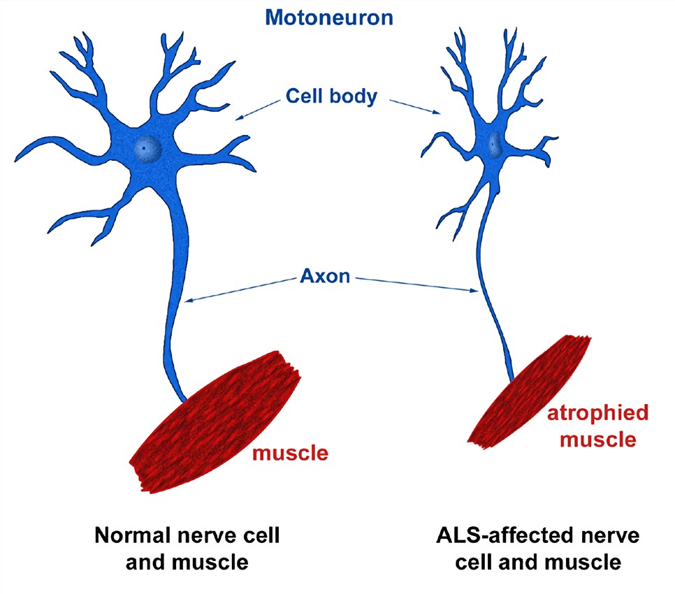 التصلب الجانبي الضموري (ALS)