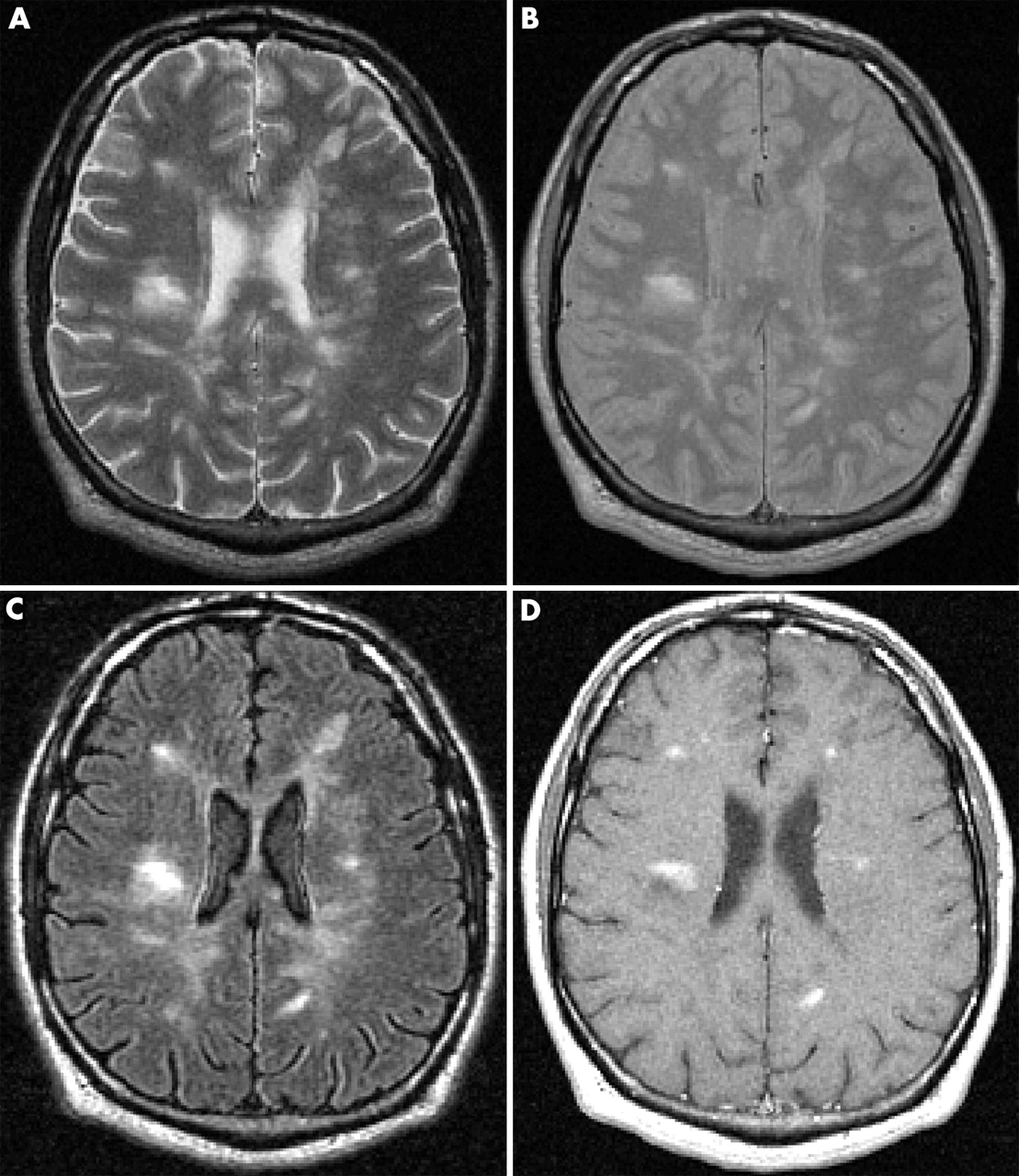 التصلب اللويحي - MRI