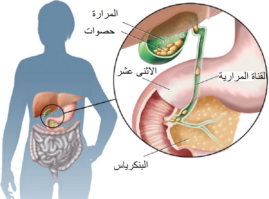 حصوات المرارة