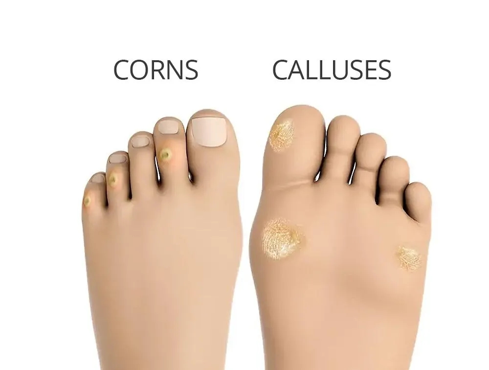Corns Foot