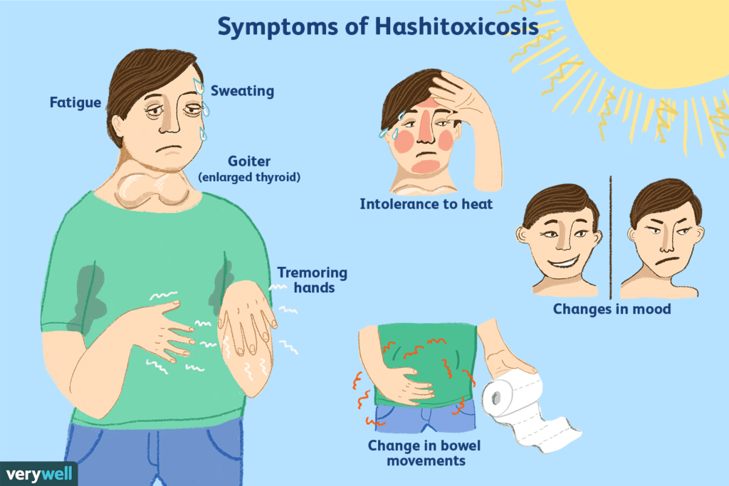 Hashimotos Disease2