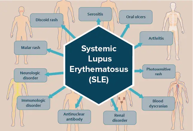 Systemic Lupus Erythematosus SLE2
