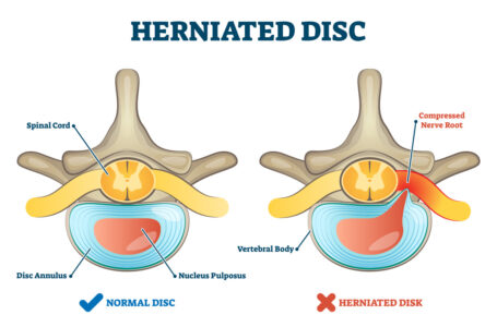 تعرف على خطر الانزلاق الغضروفي وطرق الوقاية والعلاج